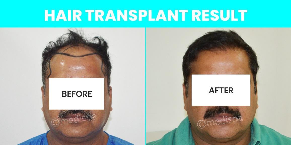 How To Speed Up Your Hair Growth After Hair Restoration