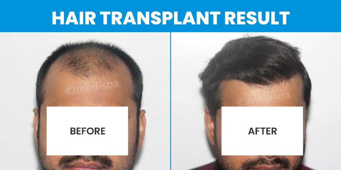 Explain The Attributes Of A Hair Transplant Surgeon