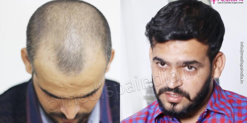 hair transplant in Delhi results