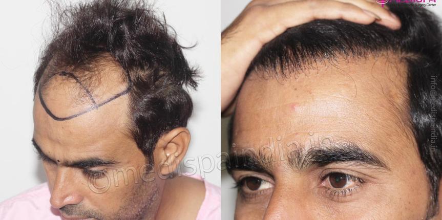 hair transplant in bikaner rajasthan