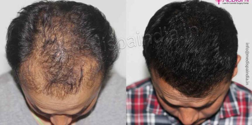 hair-restoration-india-before-after