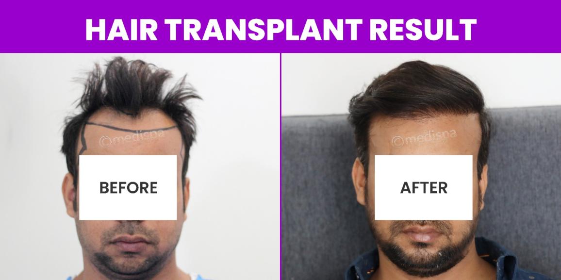 Is Hair Transplant The Best Way To Cure Pattern Baldness?