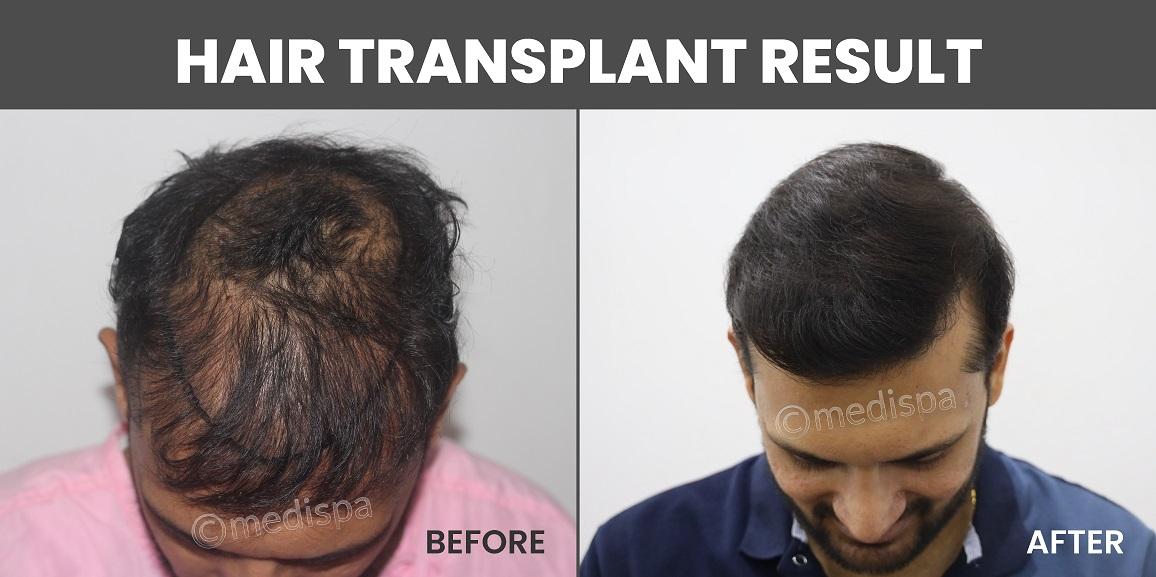 Is One Hair Transplant Treatment Enough To Last For Lifetime?