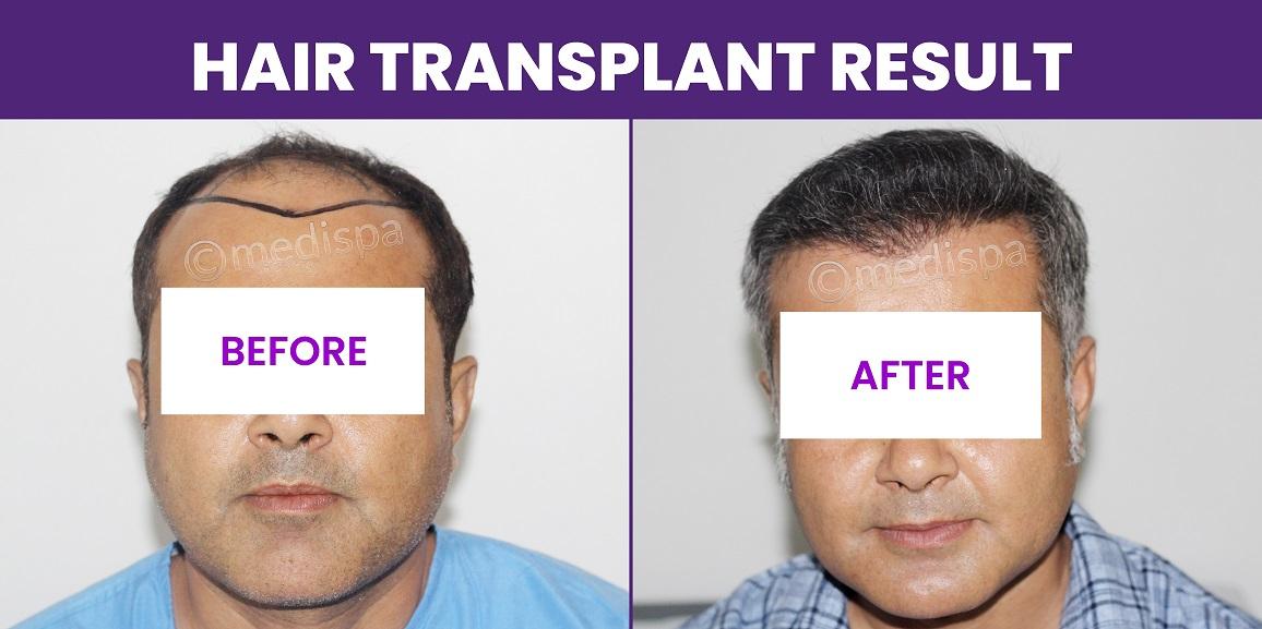 A Checklist To Hair Transplant: Things You Should Ask Your Surgeon